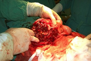 Phẫu thuật thành công cho bệnh nhân có khối u mạc treo phức tạp