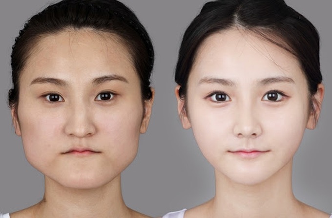 4 điều ai cũng cần "khắc cốt ghi tâm" trước khi thực hiện phẫu thuật thẩm mỹ: Chuyên gia khuyên chị em phải nắm rõ! - Ảnh 4. 4 điều ai cũng cần "khắc cốt ghi tâm" trước khi thực hiện phẫu thuật thẩm mỹ: Chuyên gia khuyên chị em phải nắm rõ! - Ảnh 4.