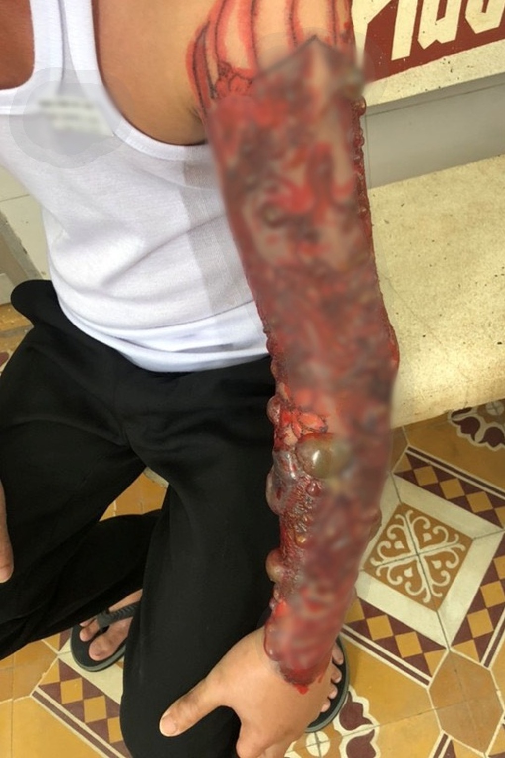 Nhiều người biến dạng mặt, nhiễm trùng tay chân nặng vì đi xăm và xóa xăm - 1 Nhiều người biến dạng mặt, nhiễm trùng tay chân nặng vì đi xăm và xóa xăm - 1