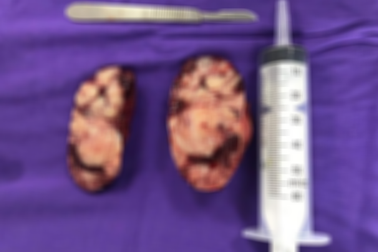 Bé 19 tháng bụng ngày một to lên vì khối u thượng thận