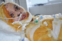 Nổ bình ắc quy xe đạp điện, chàng trai 19 tuổi bị bỏng thập tử nhất sinh