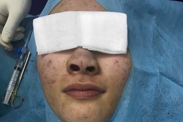 Thành “tắc kè xanh” sau khi cấy chỉ nâng mũi