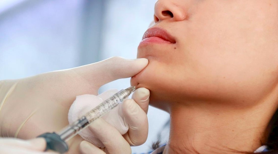 Tiêm filler cằm: Khoảng cách giữa chi phí và chất lượng - 2 Tiêm filler cằm: Khoảng cách giữa chi phí và chất lượng - 2