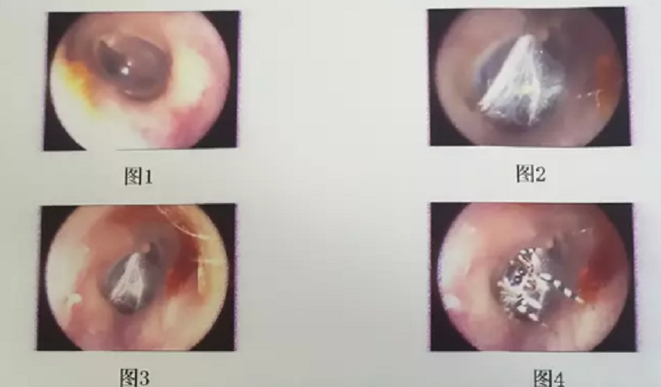 Nhện sống trong ống tai người phụ nữ Trung Quốc - 2 Nhện sống trong ống tai người phụ nữ Trung Quốc - 2