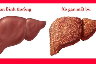 Tiềm ẩn tác dụng phụ nghiêm trọng khi dùng albumin ở bệnh nhân xơ gan mất bù.