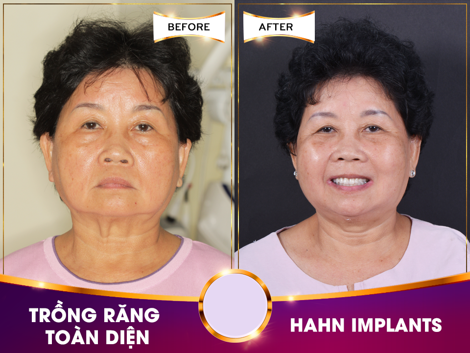 Implant nào phù hợp cho người Việt - 2