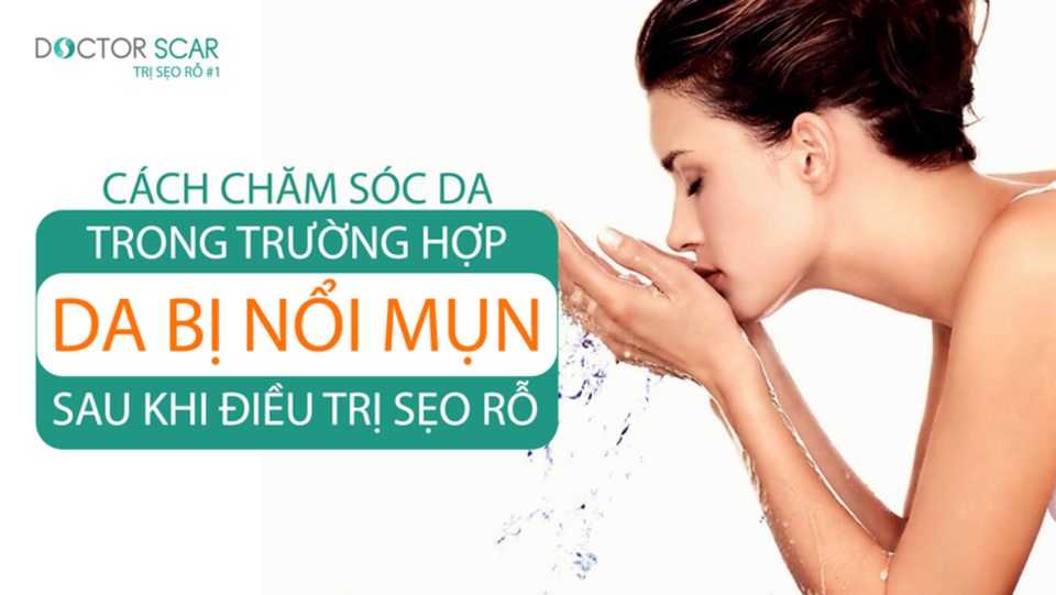 Bác sĩ da liễu giải đáp thắc mắc về việc nổi mụn sau khi điều trị sẹo rỗ - 4 Bác sĩ da liễu giải đáp thắc mắc về việc nổi mụn sau khi điều trị sẹo rỗ - 4