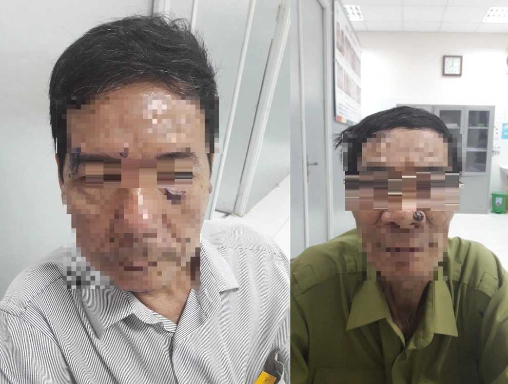 Khi nào nốt ruồi hóa ung thư? - 1 Khi nào nốt ruồi hóa ung thư? - 1
