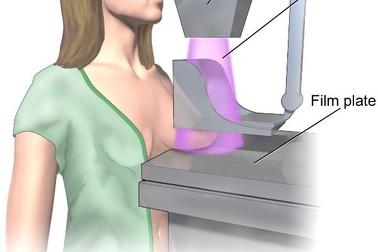 Dấu hiệu phụ nữ cần nghĩ ngay tới ung thư