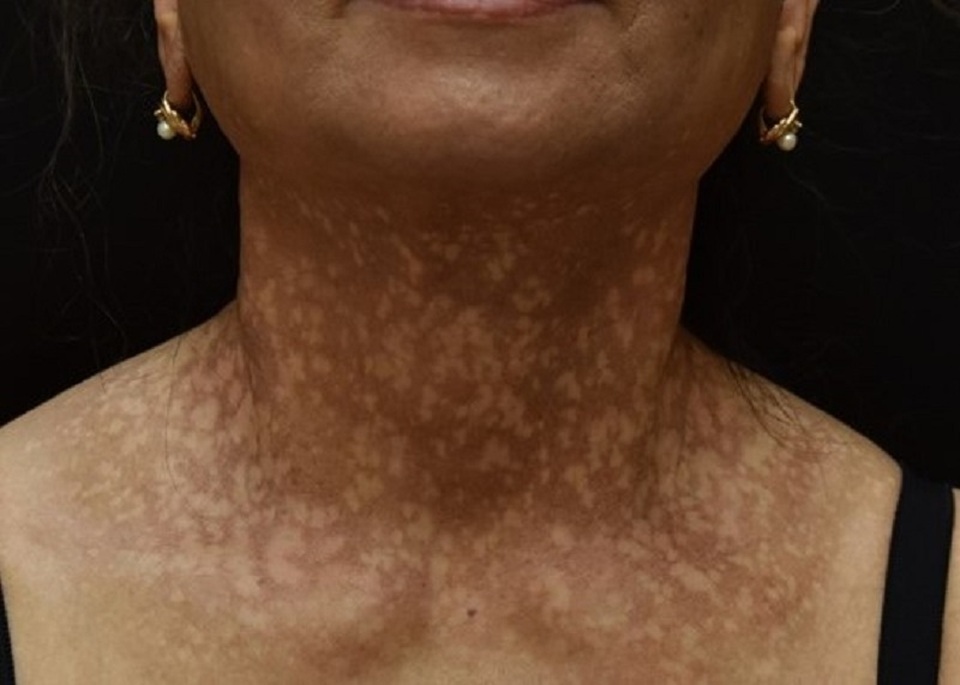 Nữ bệnh nhân bỗng nhiên đen sạm da, nửa đầu rụng hết tóc - 1 Nữ bệnh nhân bỗng nhiên đen sạm da, nửa đầu rụng hết tóc - 1