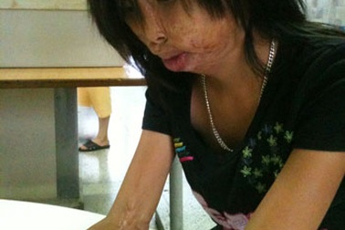 Phẫu thuật tạo hình khuôn mặt biến dạng cho một bệnh nhi