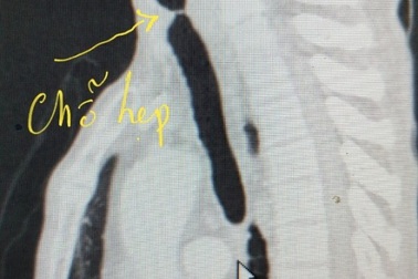 Tạo hình thành công khí quản cho bệnh nhân tắc đường thở