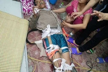 Trèo chặt cây thuê, người đàn ông rơi từ độ cao 6m gãy cả 2 chân