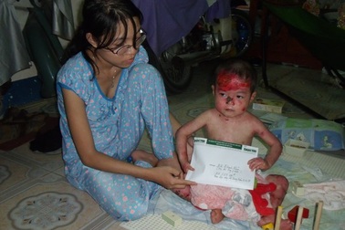 Cháu bé “ngày nào cũng bị lột da” chia sẻ cùng bé “lột da ếch”