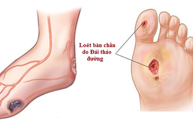 Cách chăm sóc loét bàn chân tiểu đường nhanh lành, tránh đoạn chi