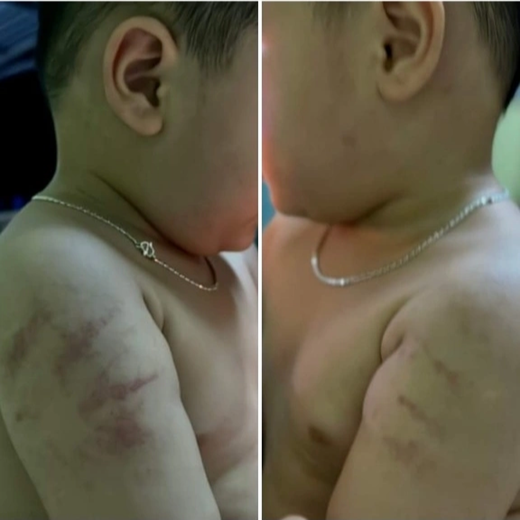 Liên tiếp 2 trẻ mầm non bị bạo hành, công an vào cuộc - 2 Liên tiếp 2 trẻ mầm non bị bạo hành, công an vào cuộc - 2