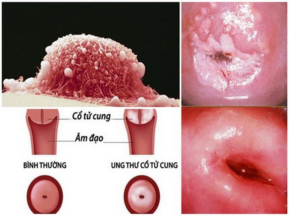 Các yếu tố rủi ro của ung thư cổ tử cung - 1 Các yếu tố rủi ro của ung thư cổ tử cung - 1