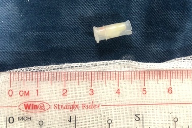 Còi đồ chơi chui tọt vào phế quản bé trai 3 tuổi