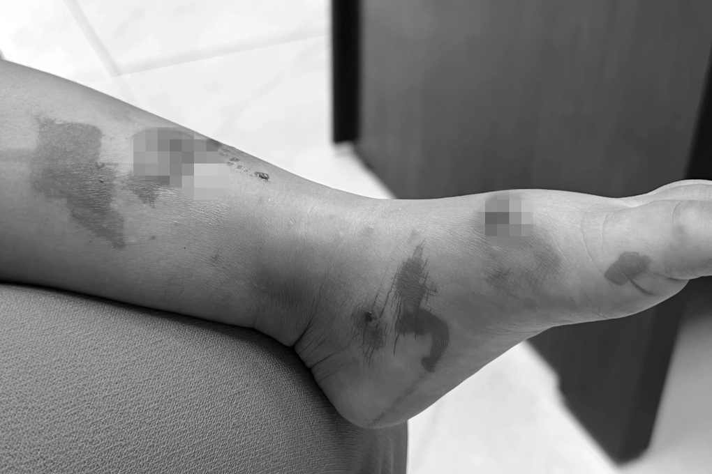 Hàng loạt cha mẹ đưa con đi viện cầu cứu vì phát bệnh chốc sau tựu trường - 1 Hàng loạt cha mẹ đưa con đi viện cầu cứu vì phát bệnh chốc sau tựu trường - 1