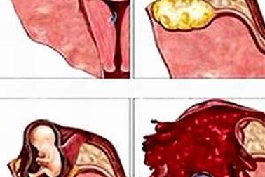 Chửa ngoài tử cung là do nạo phá thai?