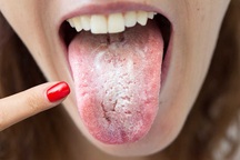 Lưỡi xuất hiện triệu chứng này coi chừng ung thư gan