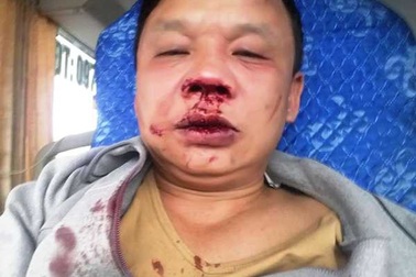 Nghệ An: Một tài xế đang chạy xe bất ngờ bị côn đồ chặn đánh đến nhập viện!