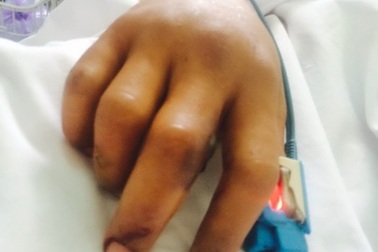 Một thanh niên bị rắn hổ cắn nguy kịch