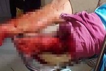 Nam thanh niên bị chém đứt lìa chân vì chê bạn “nổ”