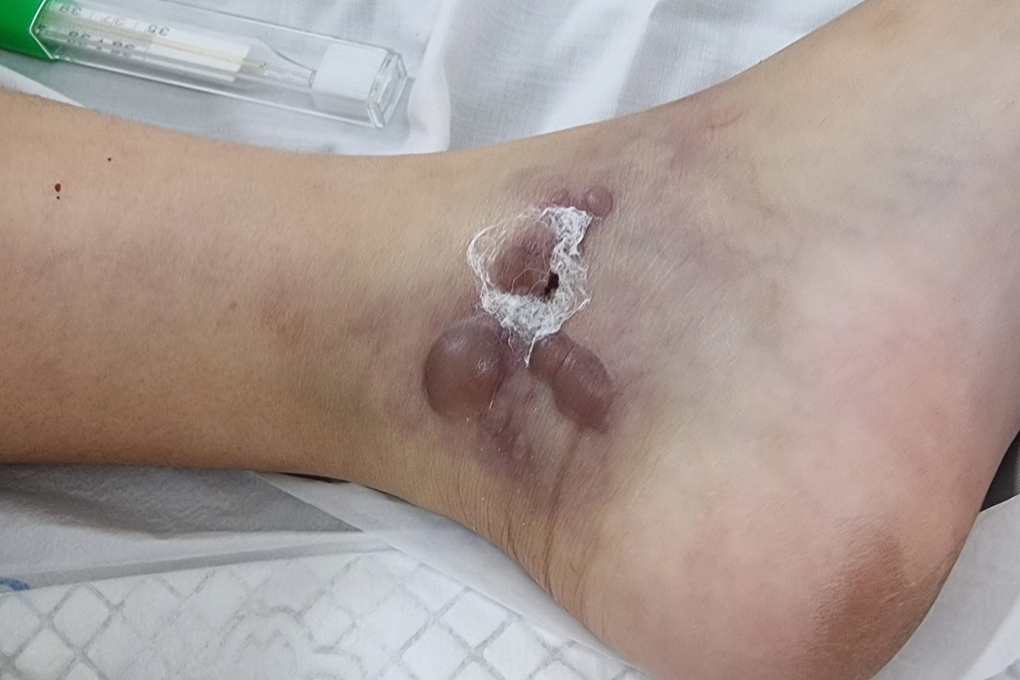 Sau trận bóng ở sân bùn đất, bé trai nguy kịch vì nhiễm vi khuẩn hiếm - 2 Sau trận bóng ở sân bùn đất, bé trai nguy kịch vì nhiễm vi khuẩn hiếm - 2