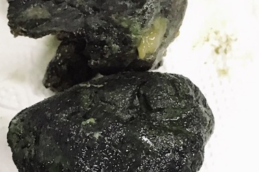 Nam thanh niên bị tắc ruột nghi do đam mê món... trà sữa