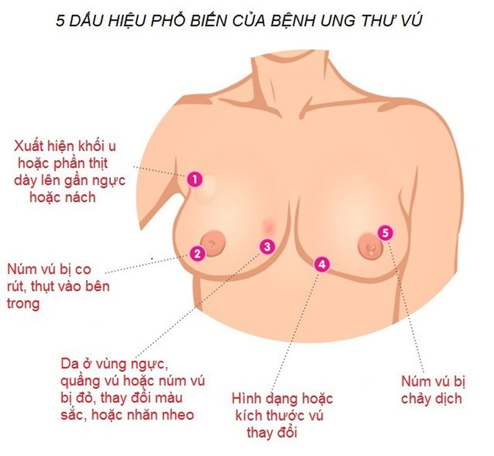 Ung thư vú có phát hiện được sớm không? - 2 Ung thư vú có phát hiện được sớm không? - 2
