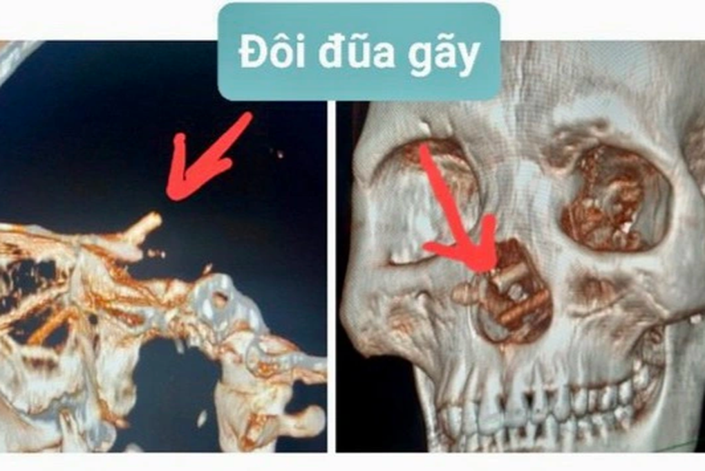 Hy hữu, bị đũa đâm xuyên từ mũi lên sọ não, 5 tháng sau mới biết - 1 Hy hữu, bị đũa đâm xuyên từ mũi lên sọ não, 5 tháng sau mới biết - 1
