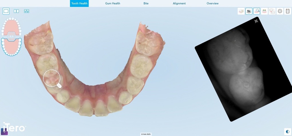 Ánh sáng cận hồng ngoại - phương pháp phát hiện sớm sâu răng mặt bên - 2 Ánh sáng cận hồng ngoại - phương pháp phát hiện sớm sâu răng mặt bên - 2