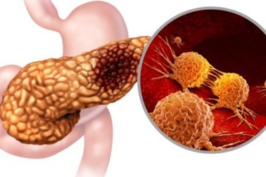 Các triệu chứng của ung thư tụy