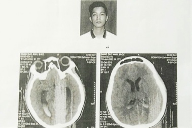 Bạc Liêu: Khởi tố một bị can vụ nam sinh bị đánh chấn thương não