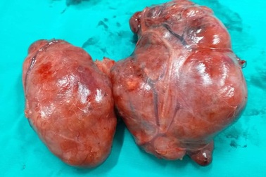 Phẫu thuật thành công u bướu “khổng lồ” ở bệnh nhân 76 tuổi