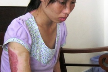 Bị chồng tưới xăng đốt, vợ vẫn viết đơn xin khoan hồng