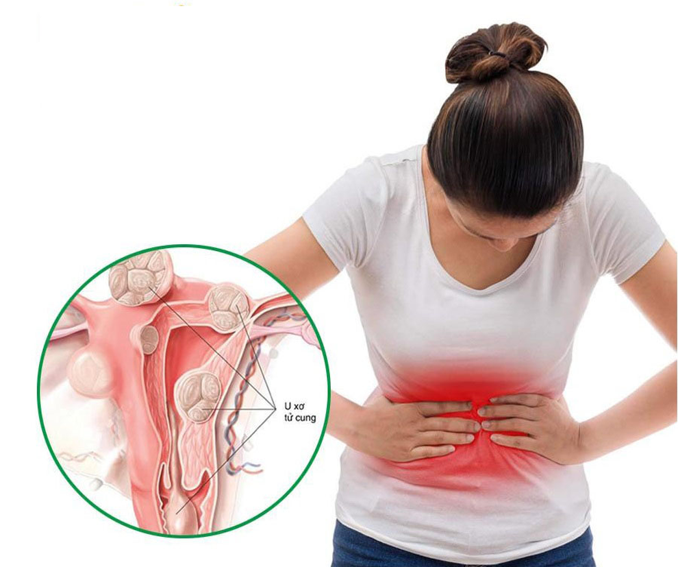 Hỗ trợ hạn chế mổ u xơ tử cung nhờ dùng Nga Phụ Khang - 2 Hỗ trợ hạn chế mổ u xơ tử cung nhờ dùng Nga Phụ Khang - 2