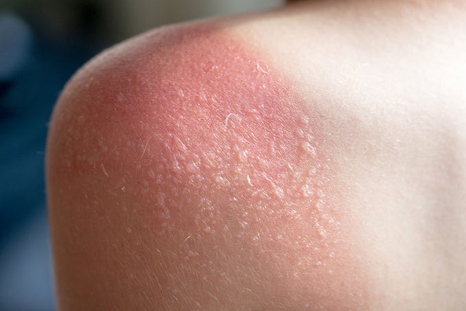 Tác động trực tiếp của tia UV trong ánh nắng gây hại lên da. Ảnh minh hoạ