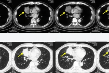 Phát hiện ung thư phổi sau 7 ngày ho tức ngực