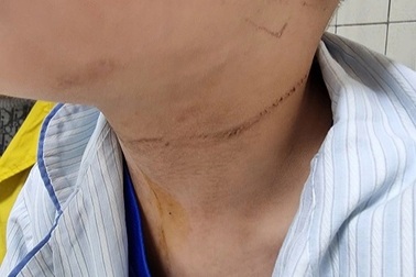 Bé 5 tuổi nghịch dây quần áo, bị dây thắt vào cổ