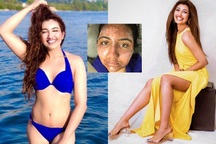 Á hậu Shree Saini kể chuyện bị bỏng mặt kinh hoàng sau tai nạn ô tô