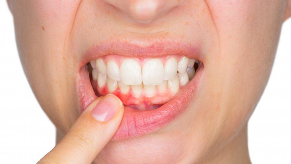 Ung thư đường tiêu hóa rình rập chỉ vì lười... đánh răng - 1 Ung thư đường tiêu hóa rình rập chỉ vì lười... đánh răng - 1