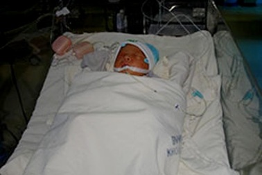 Cứu trẻ “ngạt trắng” sau sinh bằng phương pháp hạ thân nhiệt