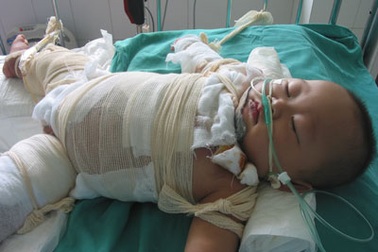 Xót xa trước tai nạn bỏng của bé 11 tháng tuổi