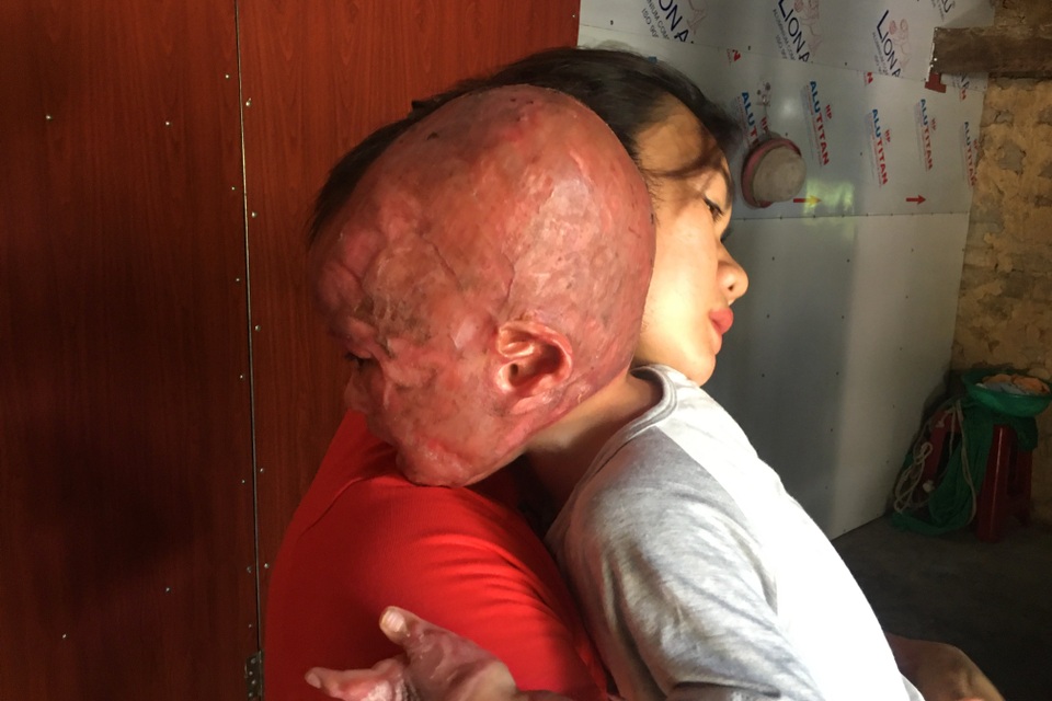 Đau nhói lòng cảnh cậu bé 2 tuổi bị bỏng xăng nặng do chơi trò sinh nhật - 2 Đau nhói lòng cảnh cậu bé 2 tuổi bị bỏng xăng nặng do chơi trò sinh nhật - 2