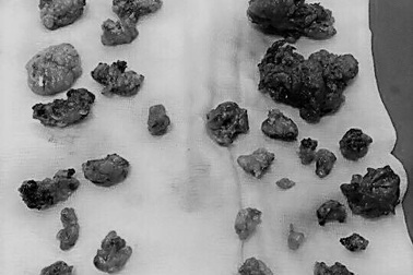 Thấy tức nặng vùng cổ, ngỡ ngàng phát hiện ung thư tuyến giáp di căn