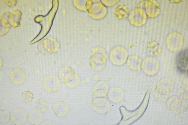 Ấu trùng sán dây chó chui vào phổi vì mê ăn thịt cừu tái, món gỏi