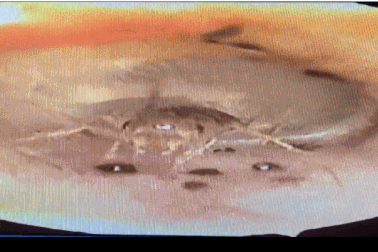 Rùng mình dế làm tổ trong tai người