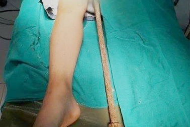 Bé 6 tuổi bị thanh sắt đâm xuyên ổ bụng khi chơi đùa